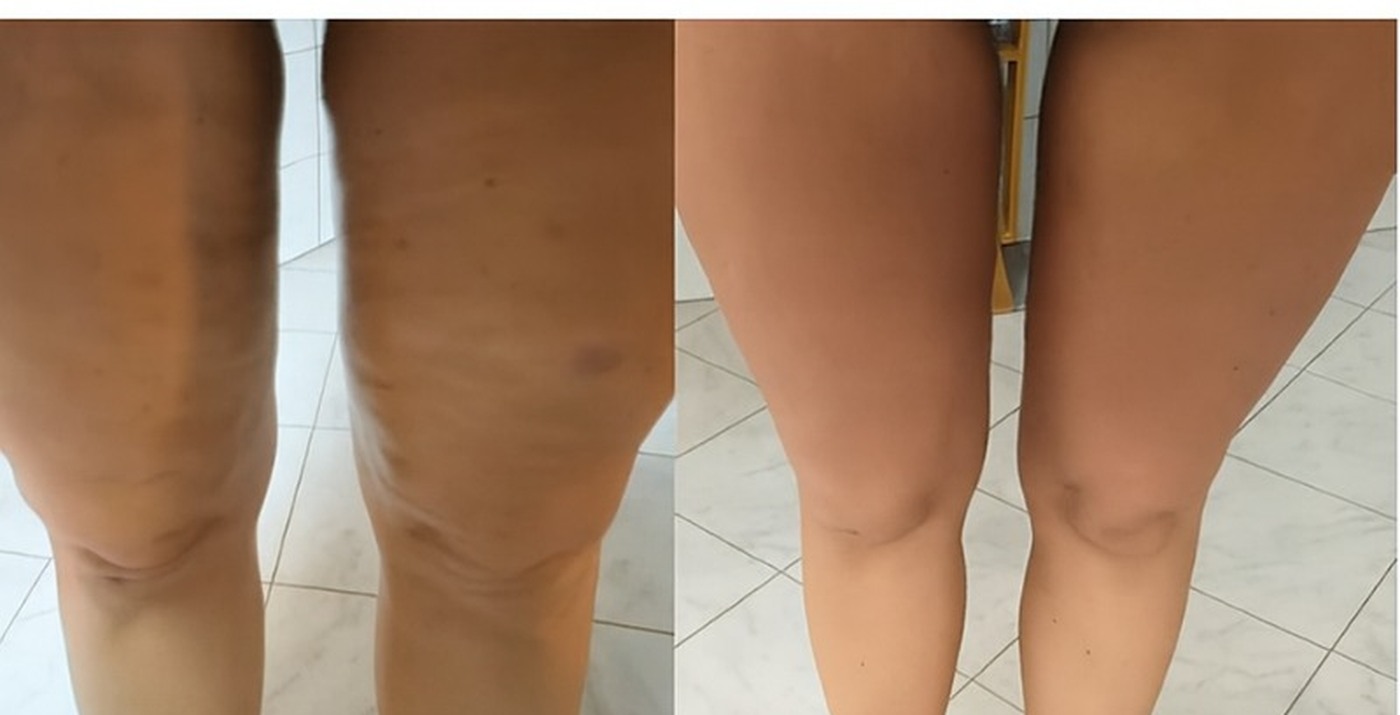 Back of thigh, before and after