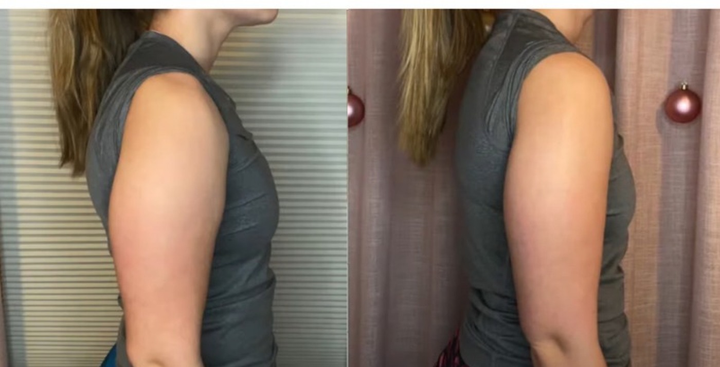 Upper arm, before and after