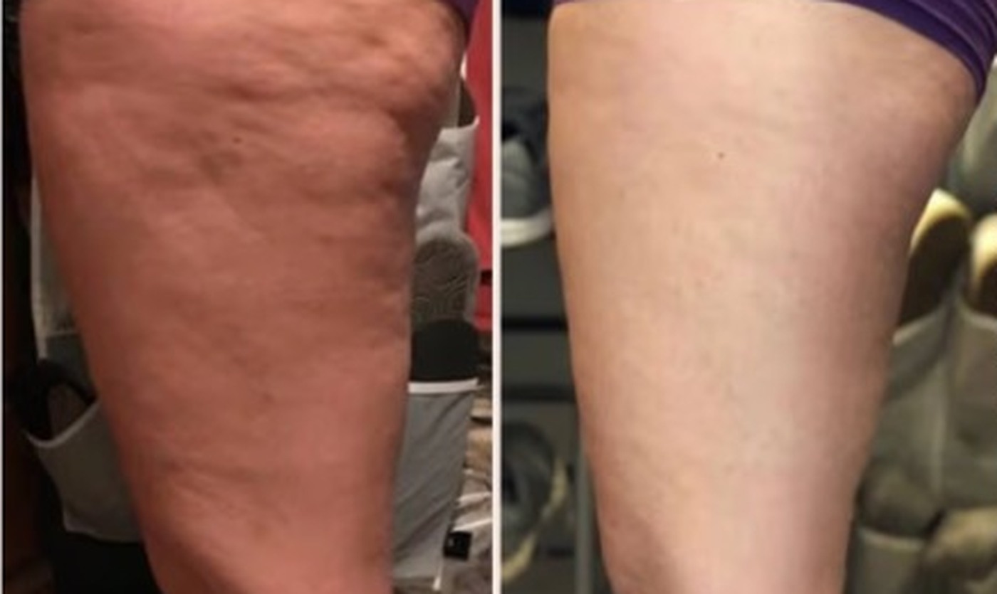 Front of thigh, before and after