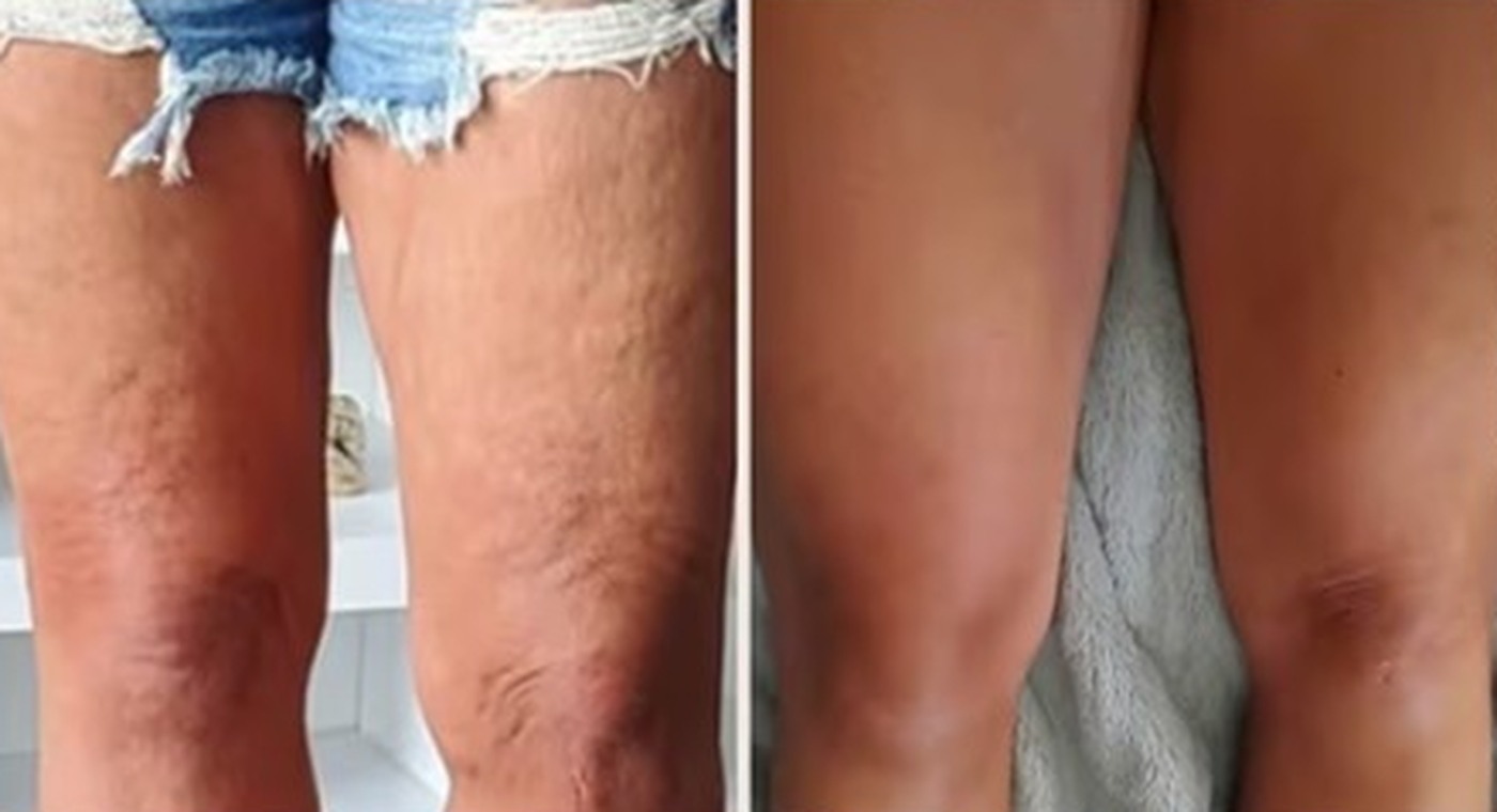 Calf and knee, before and after